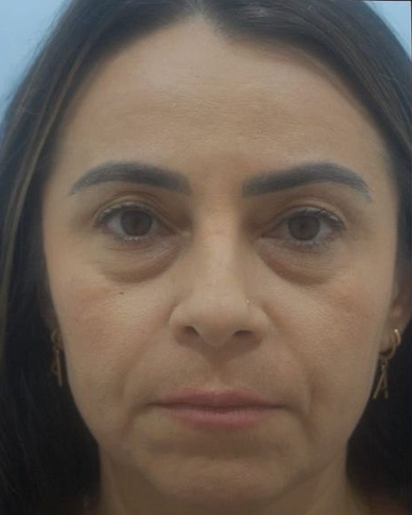 Antes — Blefaroplastia