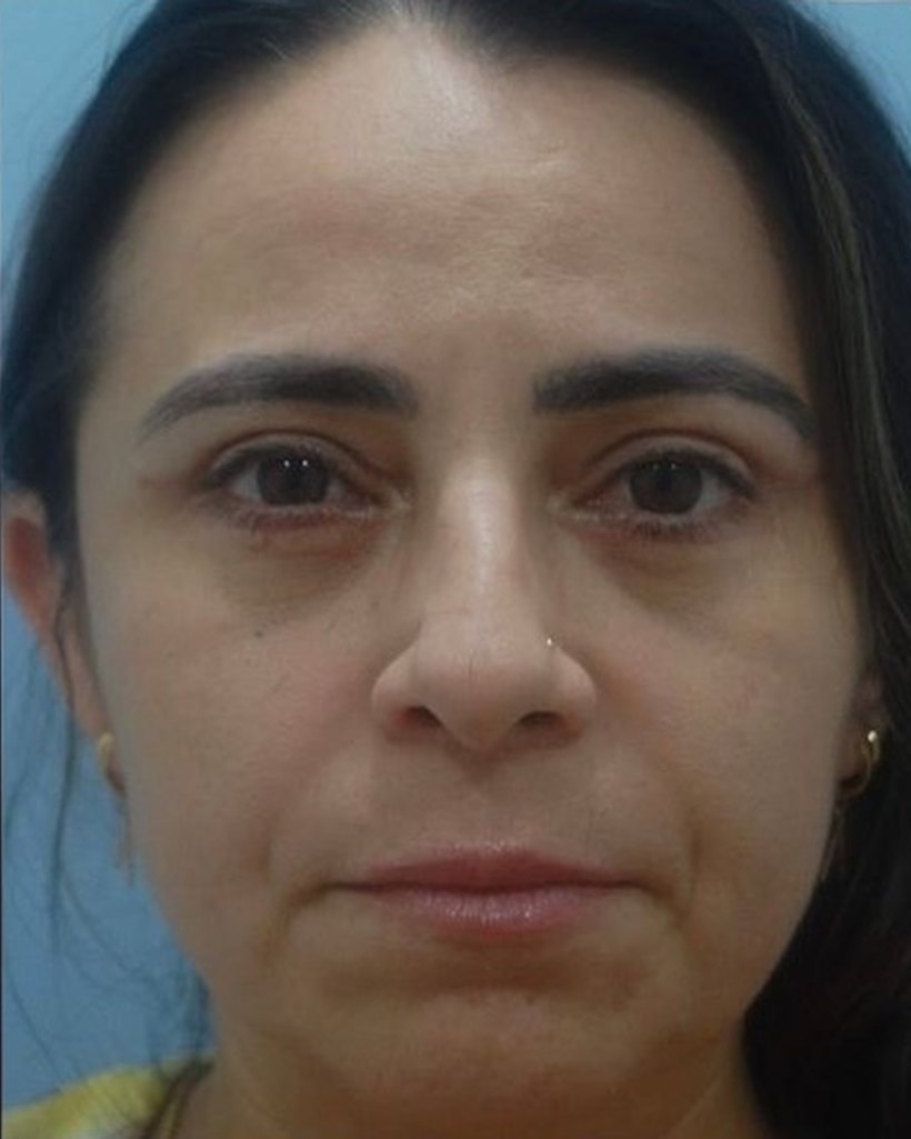 Depois — Blefaroplastia