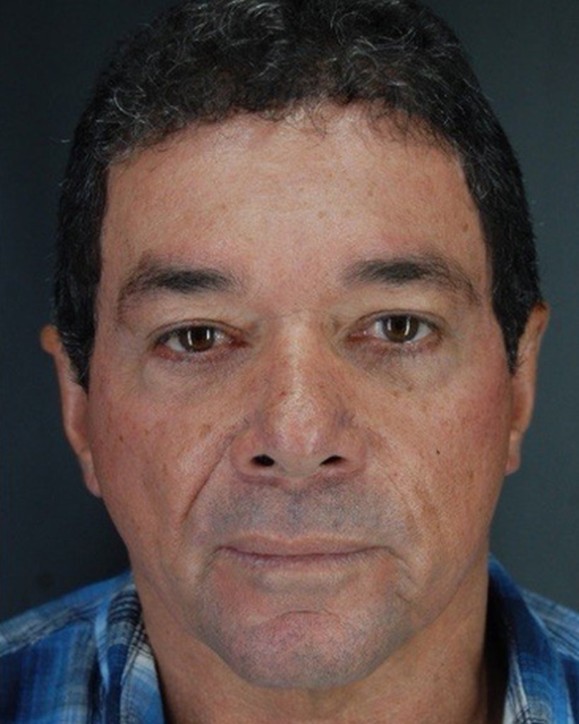 Depois — Fullface + Otoplastia + Blefaroplastia