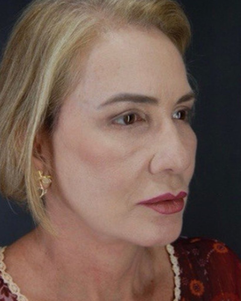 Depois — Lifting Estendido