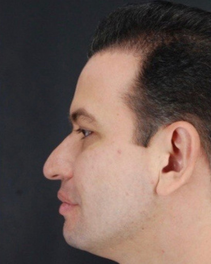 Antes — Rinoplastia