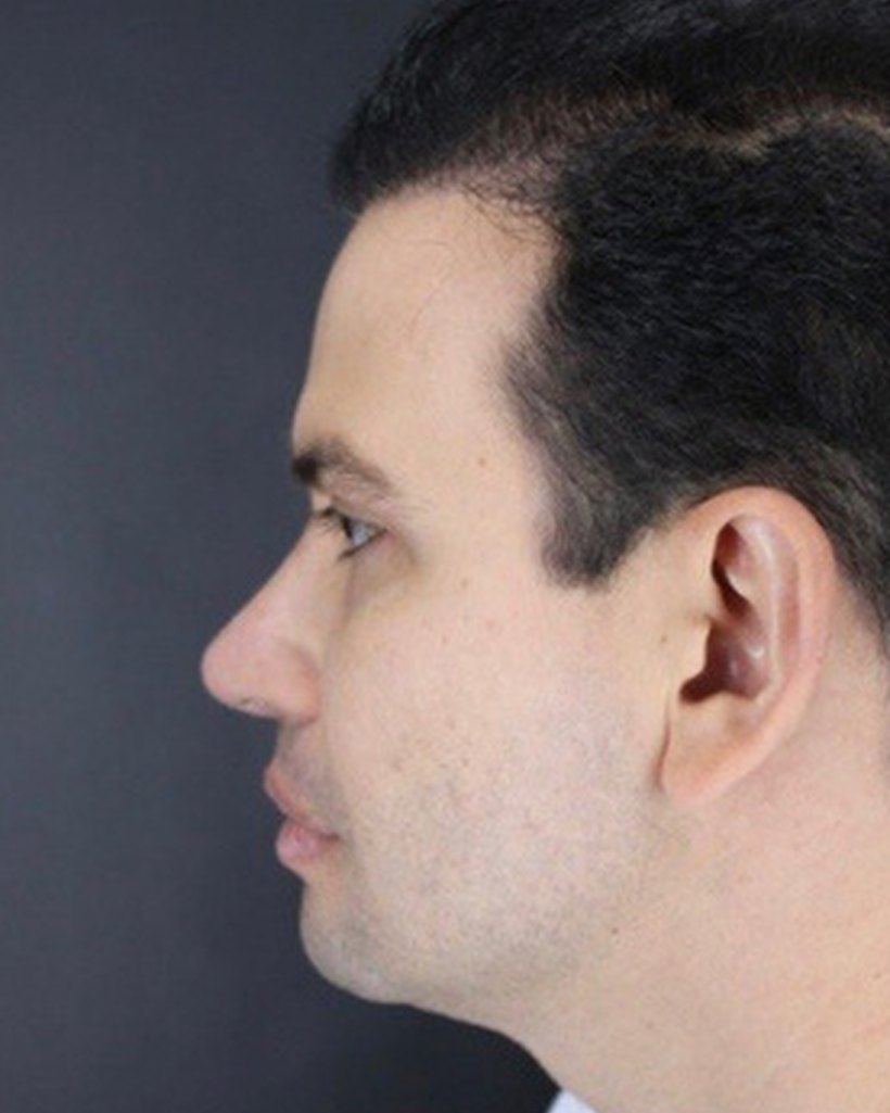 Depois — Rinoplastia