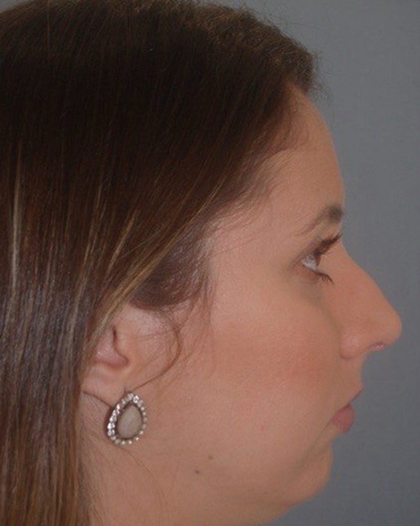 Antes — Rinoplastia + Mentoplastia
