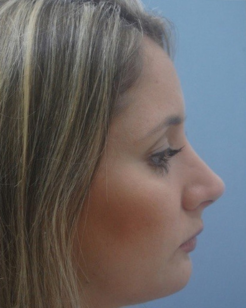 Depois — Rinoplastia + Mentoplastia