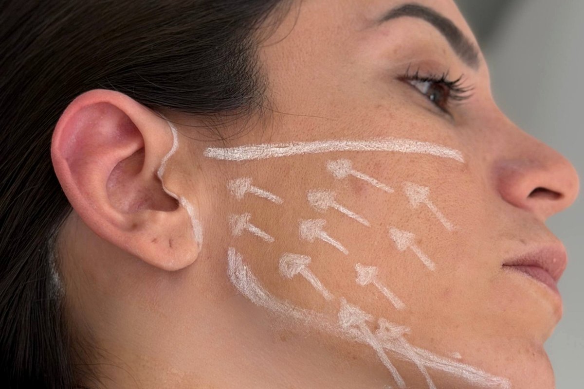 Lift do Terço Inferior da Face — Dr. Niro Reis