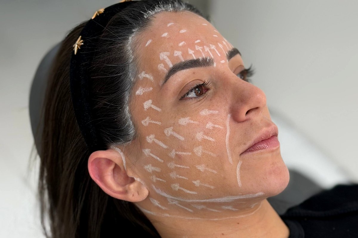 Full Facelift — Dr. Niro Reis