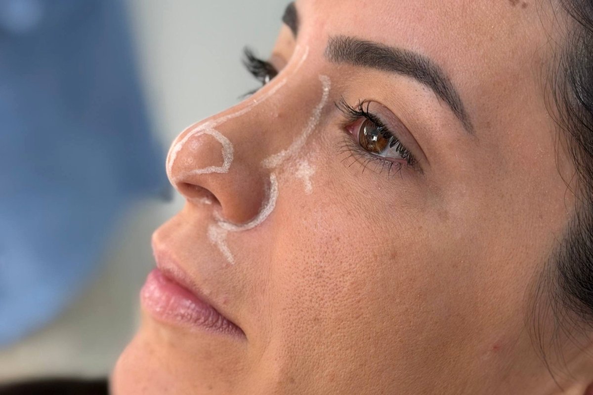 Rinoplastia — Dr. Niro Reis
