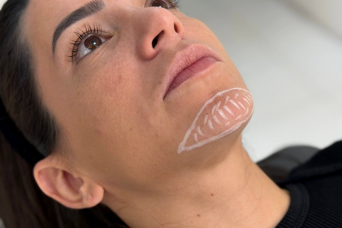Mentoplastia — Dr. Niro Reis