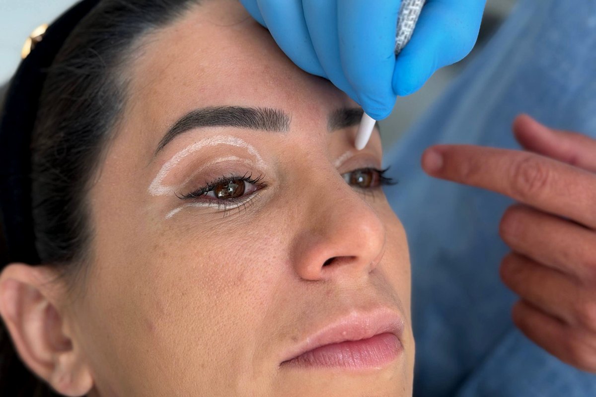 Blefaroplastia — Dr. Niro Reis