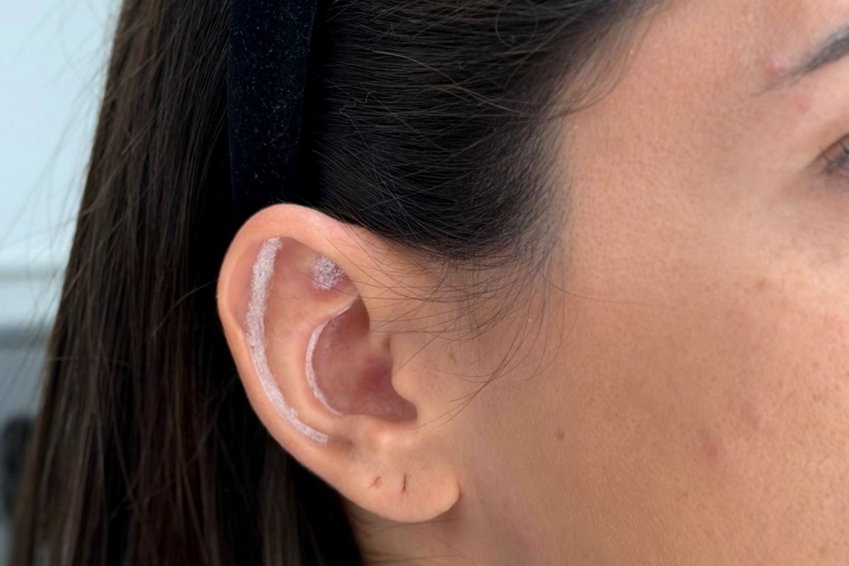 Otoplastia — Dr. Niro Reis