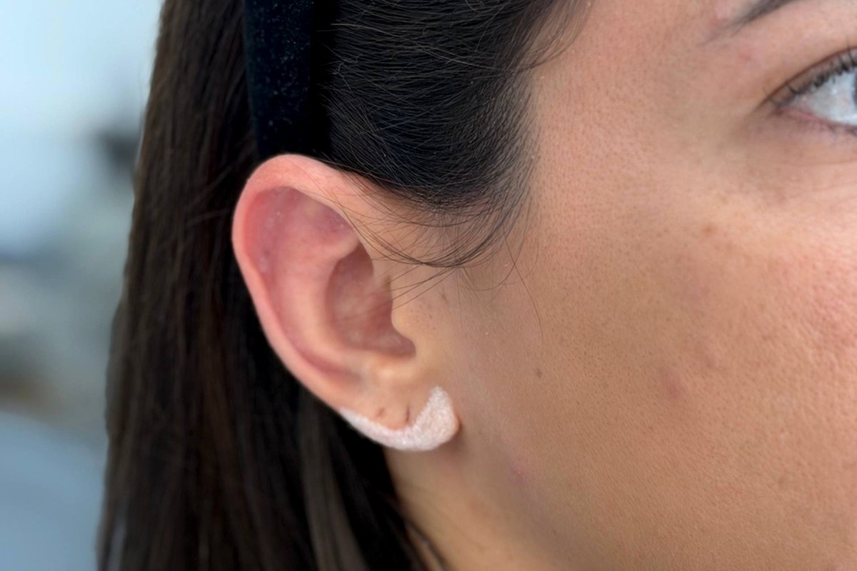 Lobuloplastia — Dr. Niro Reis