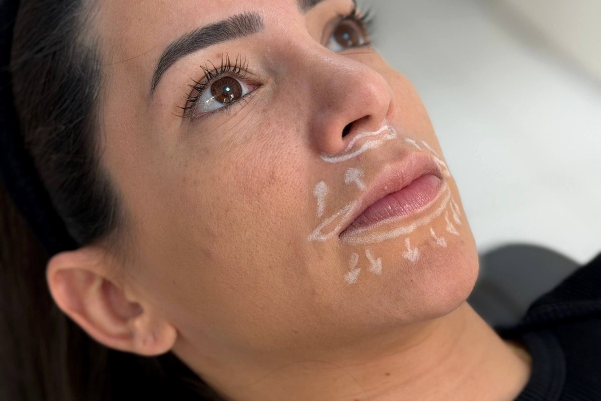 Rejuv Lip Técnica Autoral — Dr. Niro Reis